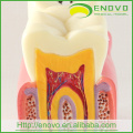 Modèle de dents pathologiques dentaires EN-M2 de 6Ttimes Caries Comparation